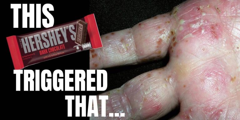 Image showing a 40g Hershey’s dark chocolate bar next to a psoriasis flare on the hand, illustrating the question: can chocolate trigger psoriasis?